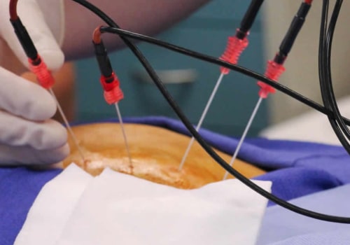 What is the Success Rate of Facet Joint Injections?