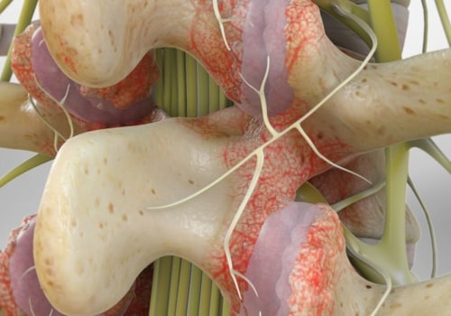Can I Drive After Facet Joint Injections?