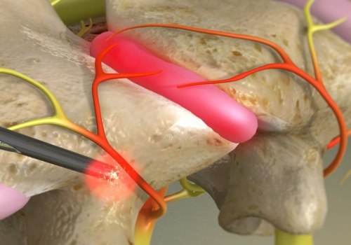 How Long Does a Facet Joint Nerve Block Last?