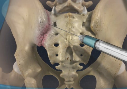 How Long Do Bilateral Facet Injections Last?
